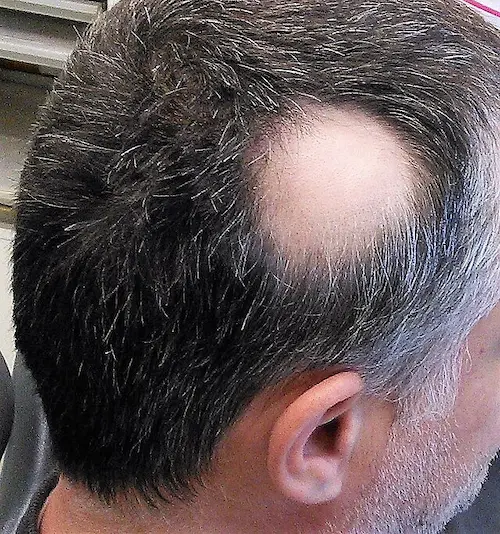 Haarausfall seitlich am Kopf zur Darstellung der Erkrankung.