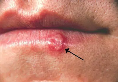 Herpes-simplex-Läsion an der Unterlippe mit Pfeilmarkierung.