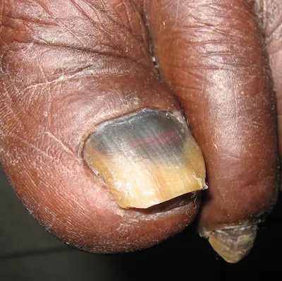 Nagelpilz mit Hematom bei einem dunklen Hauttyp, Nahaufnahme eines infizierten Zehennagels.