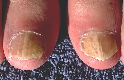 Nagelpilz an den großen Zehen mit deutlicher Verfärbung und Verdickung der Nägel, Nahaufnahme auf einem dunkelblauen Textilhintergrund.