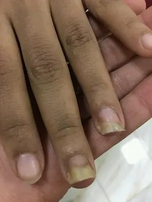 Nagelpilz an den Fingernägeln mit sichtbarer Verfärbung und Verdickung, Nahaufnahme von Händen auf hellem Hintergrund.
