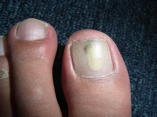 Nagelpilz am Fußzeh mit Verfärbung und Verdickung des Zehennagels, Nahaufnahme eines Fußes auf blauem Hintergrund.