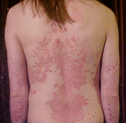 Das Bild zeigt den Rücken einer Person mit Schuppenflechte (Psoriasis), die sich durch rote, schuppige Hautflecken auszeichnet.